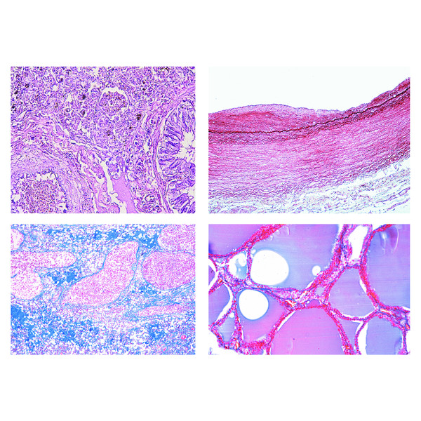 LIEDER Patologisk histologi hos människa, liten serie (50 bilder)